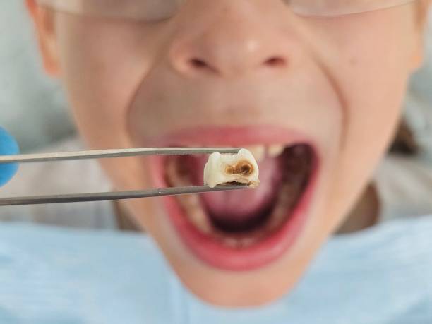 Best Cracked Tooth Emergency Dentist  in Hickman, KY